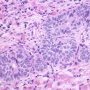 Basal Cell Hyperplasia with prominent Nucleoli in Prostate