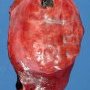 Focal nodular hyperplasia