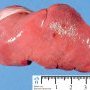 Spleen