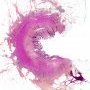Colonic stenosis in Crohn disease