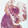 Tumoral thrombosis of the renal vein (suprarenal neuroblastoma)