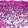 Embryonal botryoid rhabdomyosarcoma of the rhinopharynx