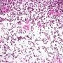Embryonal botryoid rhabdomyosarcoma of the rhinopharynx