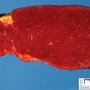 Splenic infarcts and white pulp hyperplasia (follicular lymphoid (...)