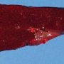 Splenic infarct