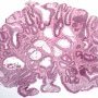 Tubulous microadenoma in FAP