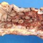 Crohn ileitis and colitis (ileocaecal region)