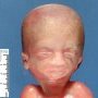 Macrocephaly by hydrocephaly (fetus, 21 weeks)