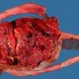 Velamentous insertion of umbilical cord