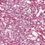 Yolk sac tumor