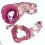 Neonatal necrotizing enterocolitis