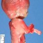 Caudal dysplasia with limb agenesis