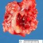 Subcutaneous abcess
