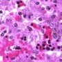 Parvoviral inclusion in fetal liver (hydrops fetalis)