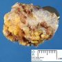Thyroglossal tract cyst
