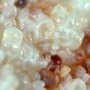 Lingual lymphangioma