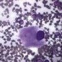Gaucher cell in bone marrow cytology