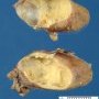 Nodal epidermoid cyst