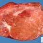 Focal nodular hyperplasia