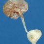 Renal adysplasia (renal agenesis and renal dysplasia)