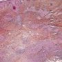 Dermal epithelioid granulomas