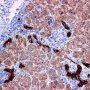 Ductular reaction or ductular proliferation (cytokeratin-7)