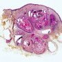 Pilomatrixoma