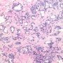 Post-atrophic Hyperplasia