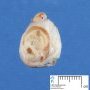 testicular juvenile-type granulosa tumor