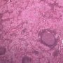 Thymic seminoma