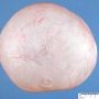 Ovarian serous cystadenoma