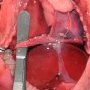Left diaphragmatic hernia (fetus, 25 weeks)