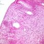 Colonic localization of an infantile myofibromatosis
