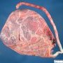 Velamentous insertion of umbilical cord