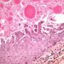 Hidrocystoma