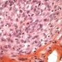 Plexiform fibrohistiocytic tumor