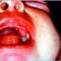 Neonatal epulis