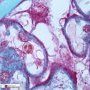 Membranous glomerulonephritis (Masson's trichrome stain)