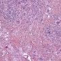 Nodal cryptococcosis (Cryptococcus neoformans)