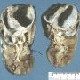 Cystic nephroma