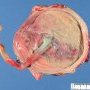 Placenta in acute chorioamnionitis