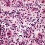 Chronic inflammation