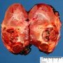 Post-chemotherapy Wilms tumor