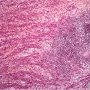 Mesenchymal component with muscular differentiation