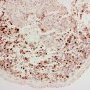 Embryonal botryoid rhabdomyosarcoma of the rhinopharynx (myogenin)