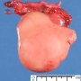Gonadoblastoma and dysgerminoma in gonadal dysgenesis
