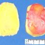 Ovarian dermoid cyst