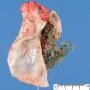 Ovarian dermoid cyst