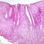 Colonic localization of an infantile myofibromatosis