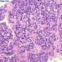 Gleason pattern 5 (WebPathology)